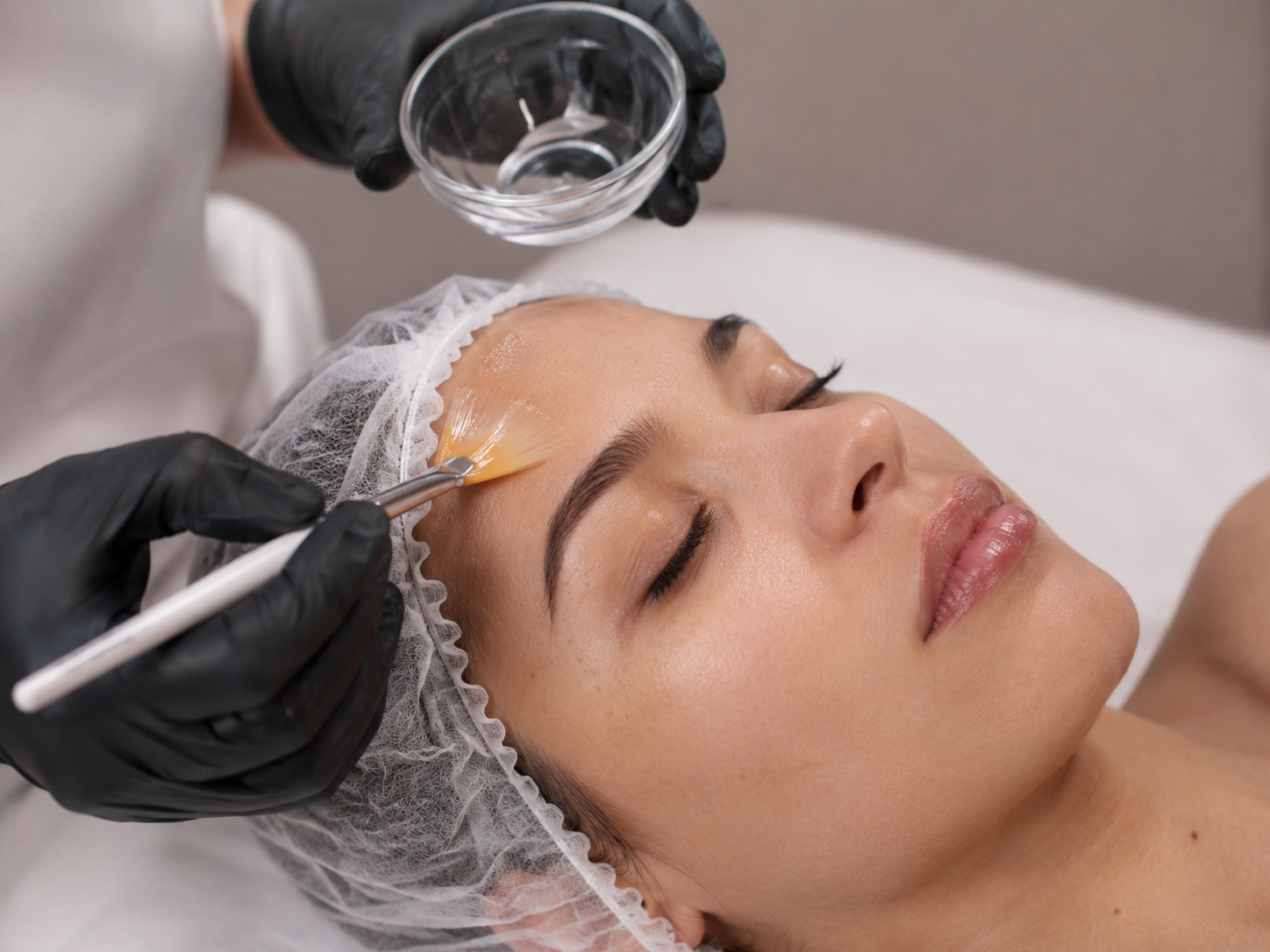 Chemical peel treatment at UR ALLURE, Orange County